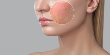 Inflammation: Understanding the Cause and Taking Control